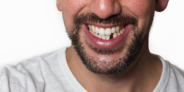 Missing Tooth