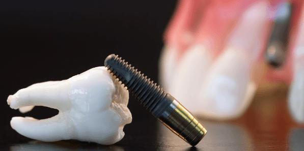 What are your options when it comes to replacing a missing tooth?