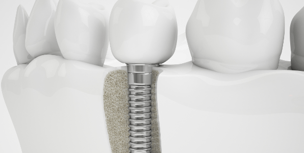 Dental implant cost varies from patient to patient depending on your oral health condition.