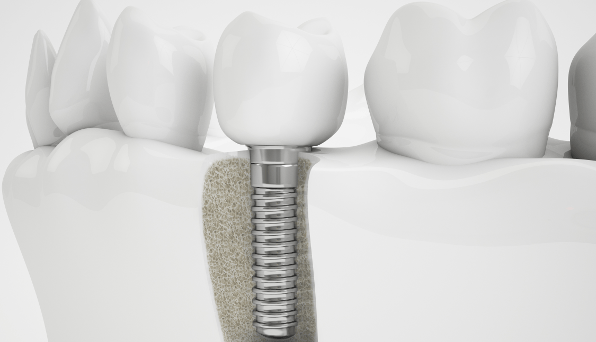 Dental implant cost varies from patient to patient depending on your oral health condition.