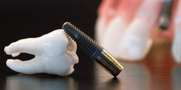 Brisbane dental implant failure