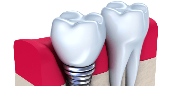best option dental implants