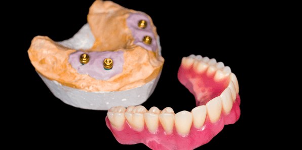 The best denture treatment is implant-supported dentures