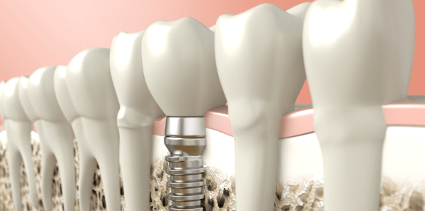 implant dentistry in Brisbane
