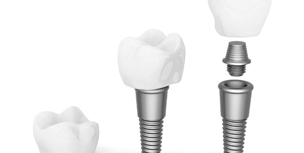 teeth implants are more commonly referred to as dental implants.