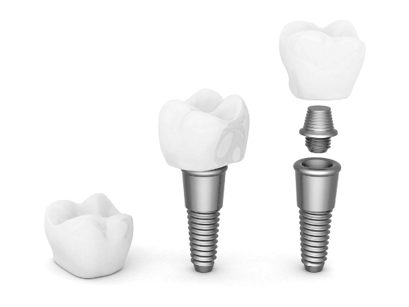 teeth implants are more commonly referred to as dental implants.