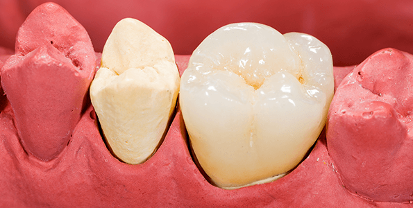 How to replace missing teeth