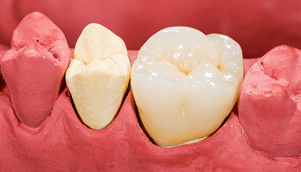 How to replace missing teeth