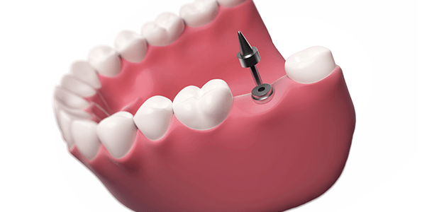 What are my options to replace missing teeth?