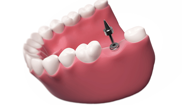 What are my options to replace missing teeth?