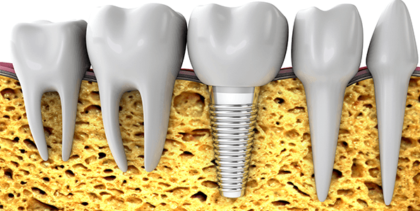Bone grafting for dental implants