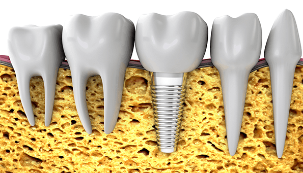 Bone grafting for dental implants