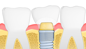 Bone grafting for dental implants