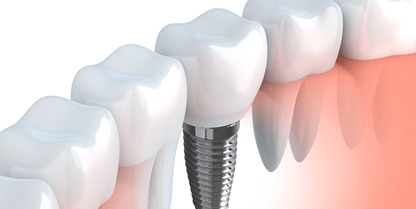 A tooth implant can help restore your chewing and speaking