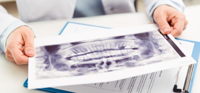 best dental implants brisbane