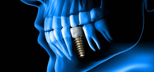 Implant Teeth Blue Scan