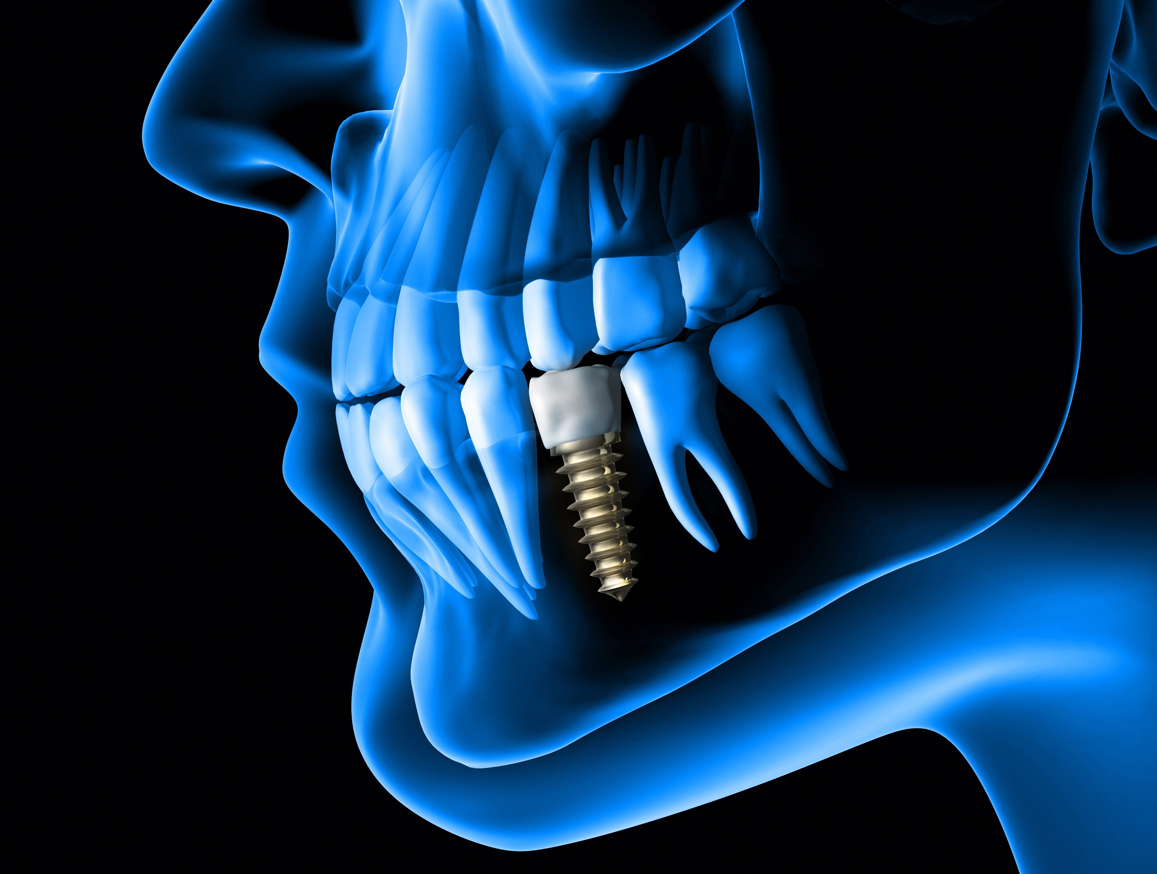 Implant Teeth Blue Scan