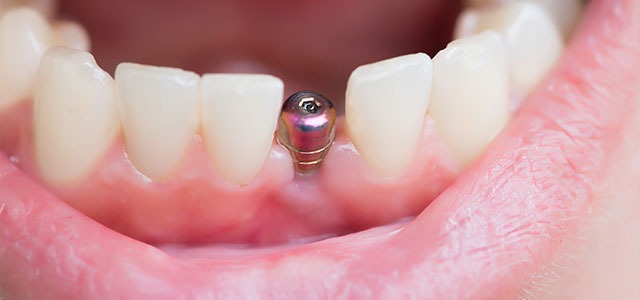 Dental Implant Screws