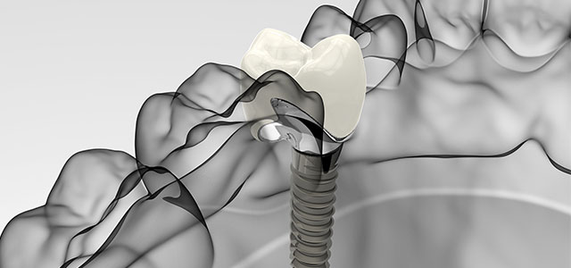 dental implants procedure