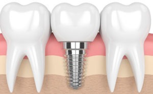 Dental Implant Between Natural Teeth