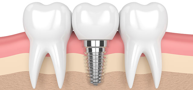 Dental Implant Between Natural Teeth