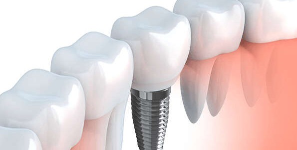 A tooth implant can help restore your chewing and speaking