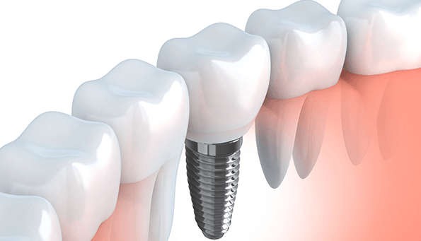 A tooth implant can help restore your chewing and speaking