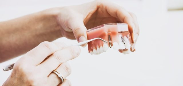 dental implants