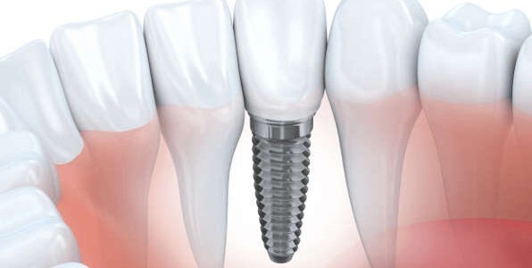 dental implants brisbane cost