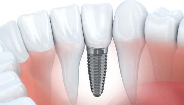 dental implants brisbane cost